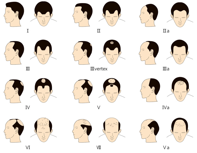 La perte de cheveux chez les hommes - Medikemos Clinic